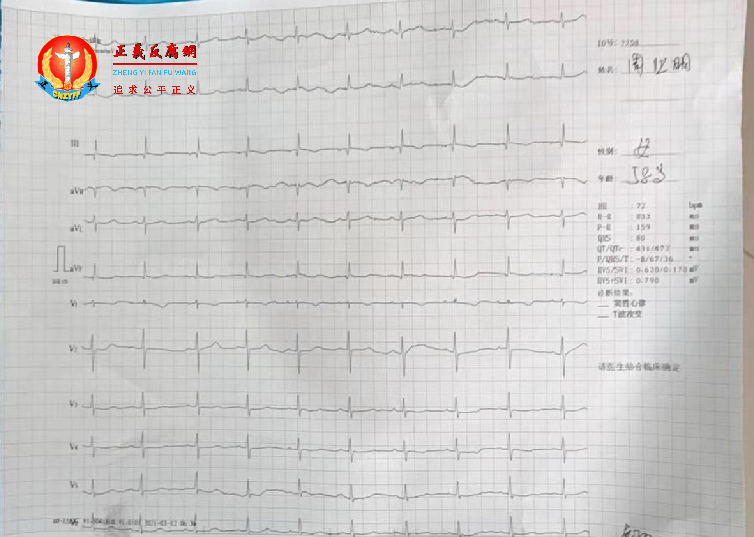 湖北访民周业明吃了警察准备的汉堡后上吐下泻，广水市马坪镇卫生院检查，心电图显示窦性心律不齐。.png