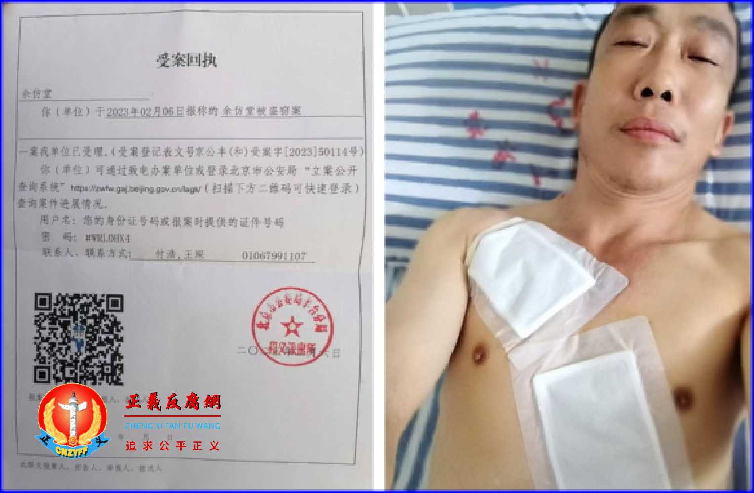 四川珙县访民余仿堂，因为被地方政府雇用监控他的人殴打，导致骨折住院。.jpg